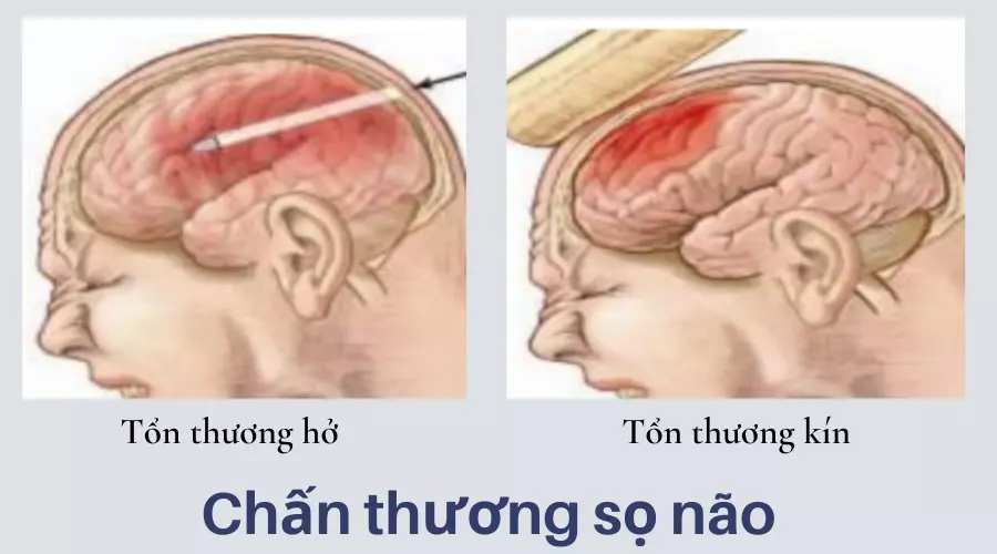 Chan-thuong-so-nao-xay-ra-do-nao-bi-ton-thuong